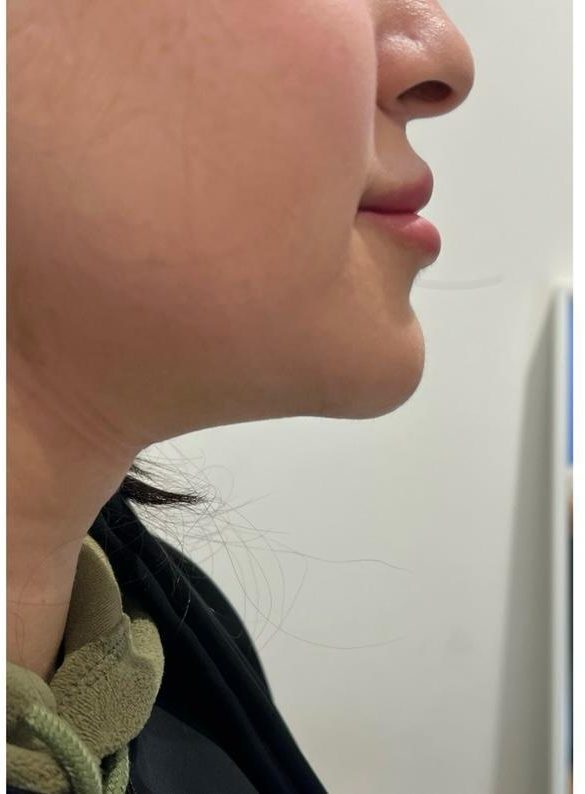Double chin case 1 after