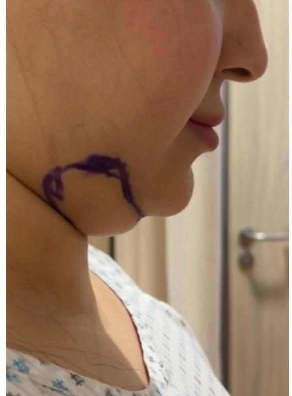 Double chin case 1 before