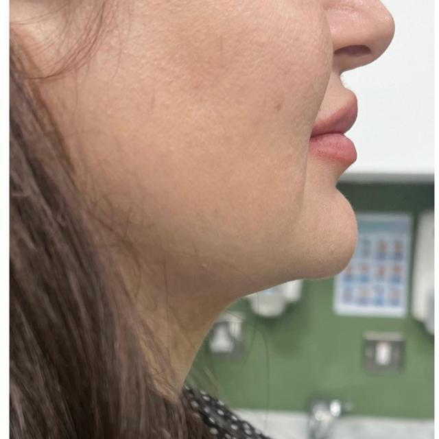 Double chin case 2 after
