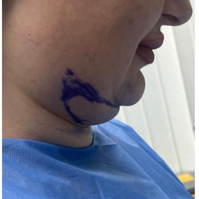 Double chin case 2 before