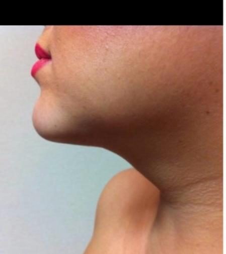 Double chin case 3 after