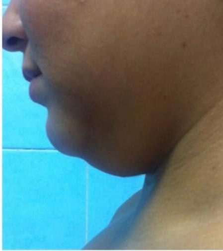 Double chin case 3 before