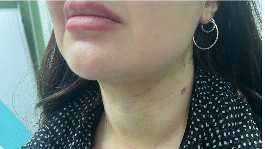 Double chin case 4 after