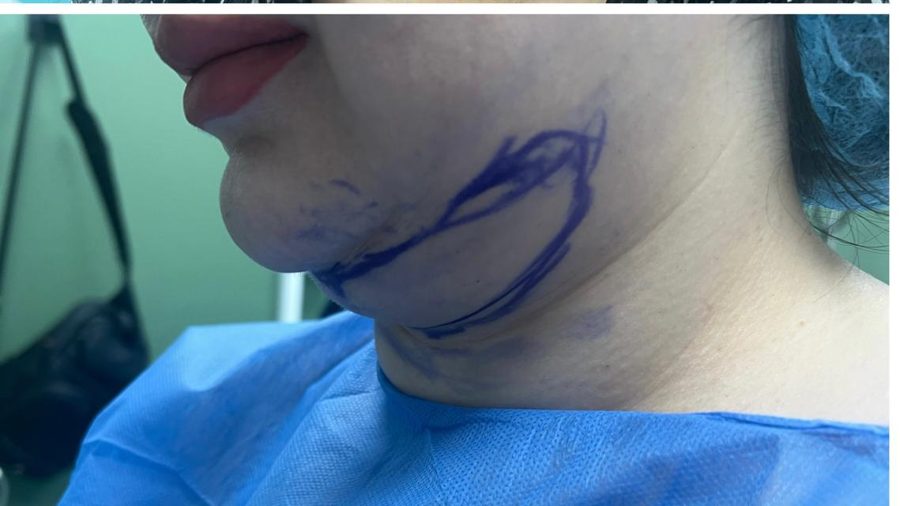 Double chin case 4 before