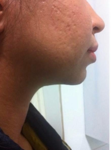 Double chin case 5 after