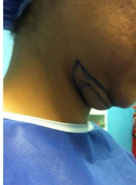 Double chin case 5 before